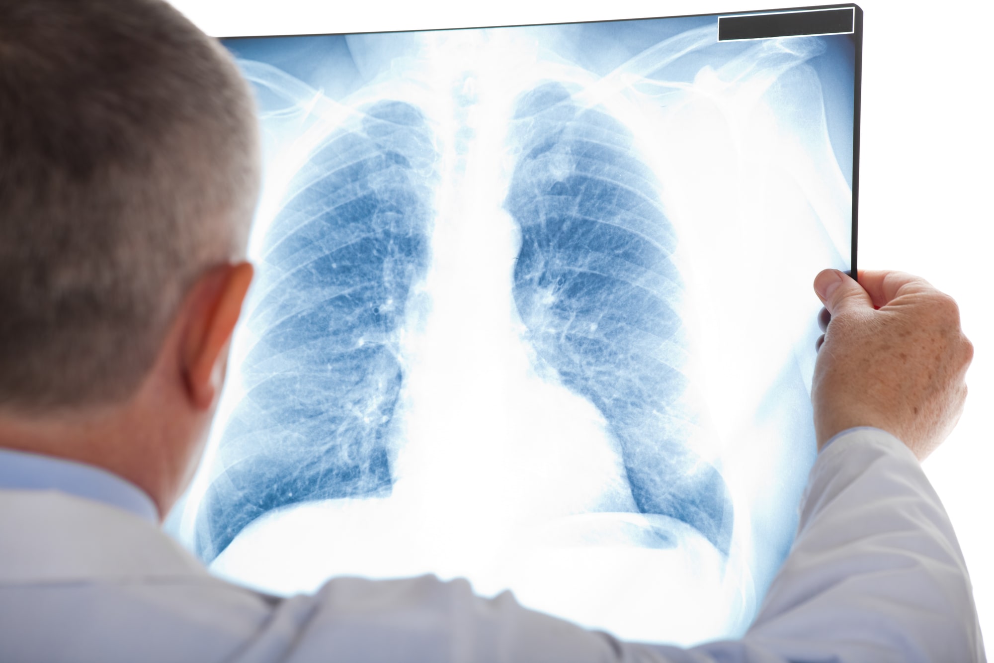 Spinal Cord Injury Lawyer Dallas, TX