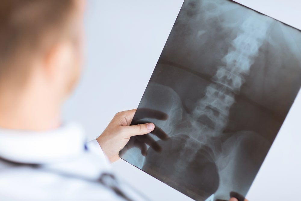 Spinal Cord Injury Lawyer Dallas, TX